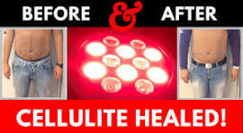 before and after photos for cellutlite