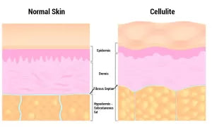 comparing a normal skin to a skin with cellulite