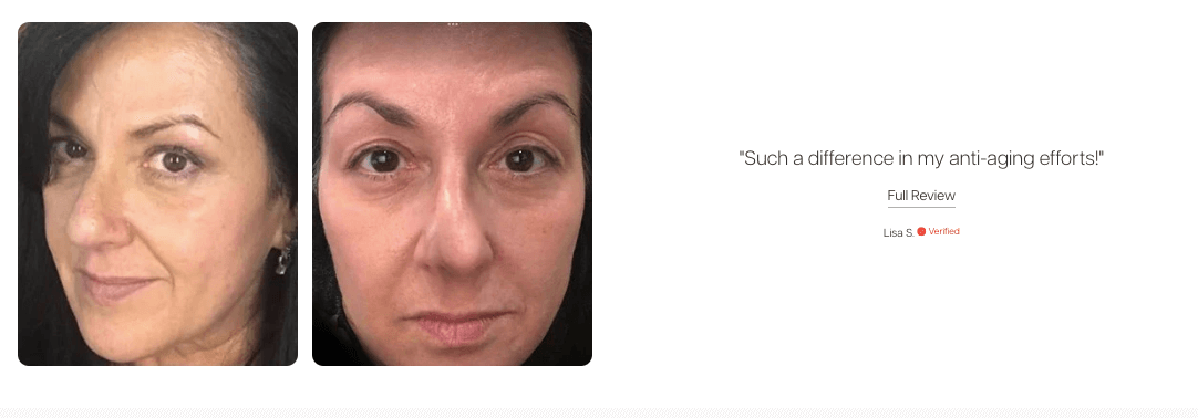 Before and after photo showing wrinkle reduction after using Mito Red Light therapy.