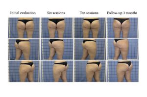science of using red light to improve cellulite