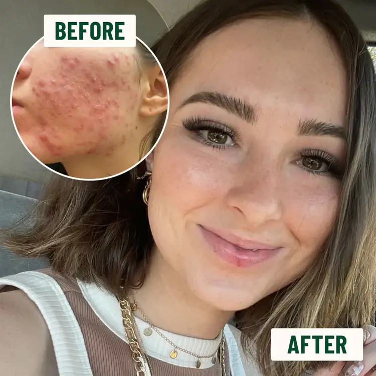 best skin care routine for teenage acne Over the counter products don't help long term to keep the skin clear from excess dirt, sun damage, and sun exposure