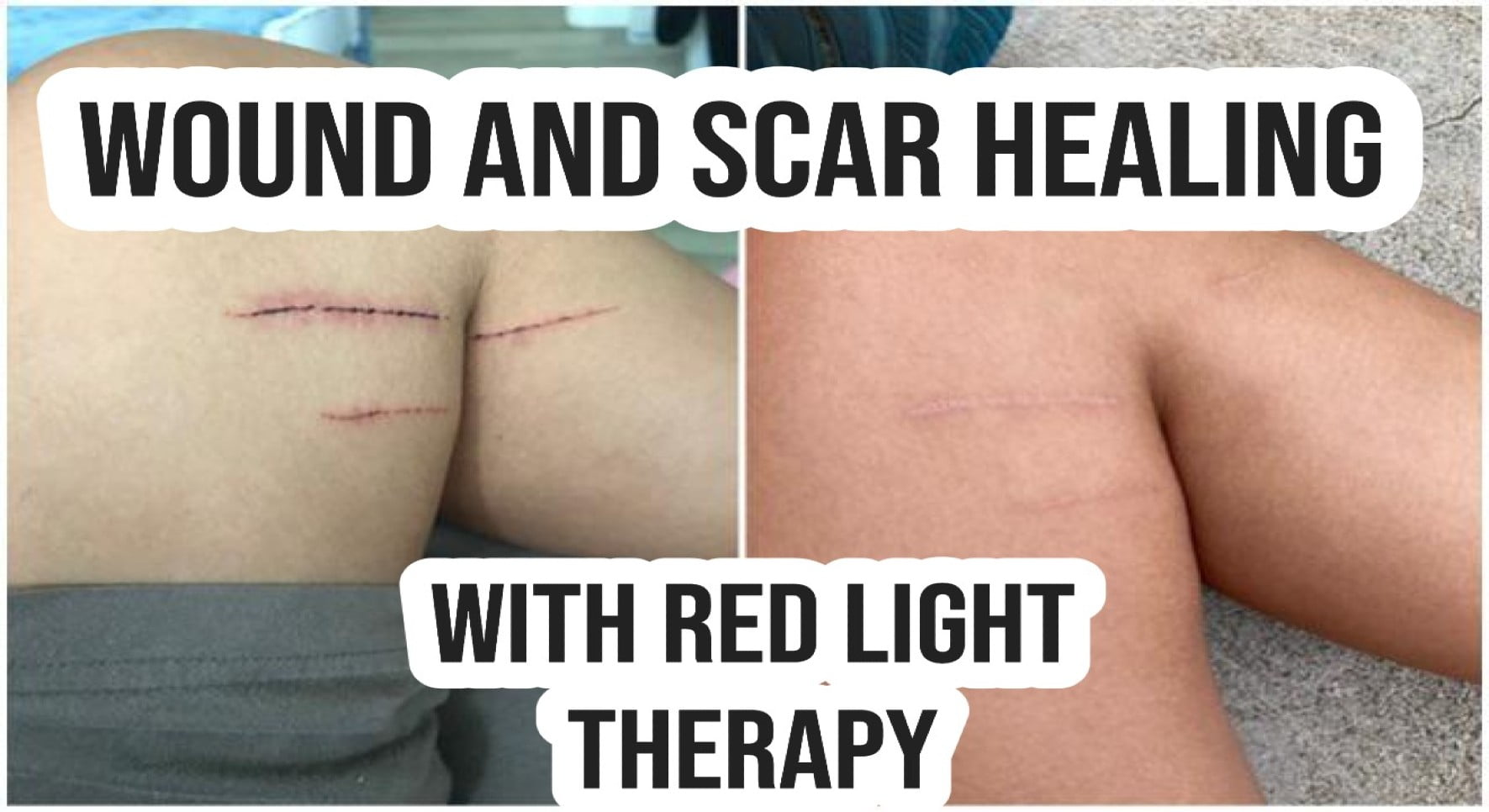 using red light therapy to improve scars